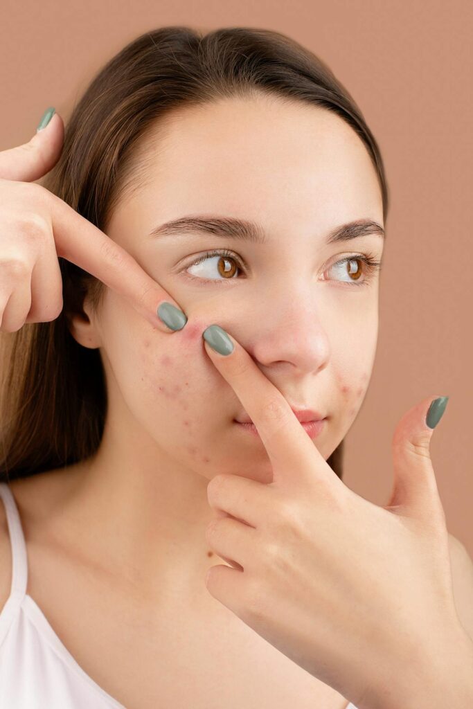 Expert Tips for Acne-Free and Glowing Skin