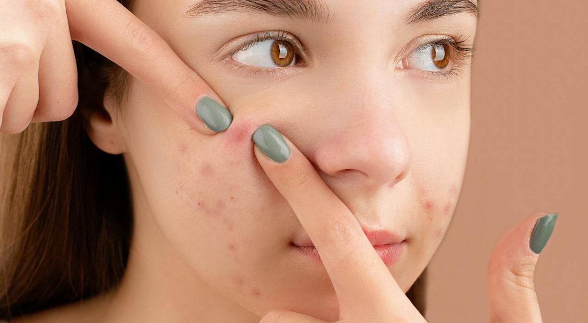 Expert Tips for Acne-Free and Glowing Skin